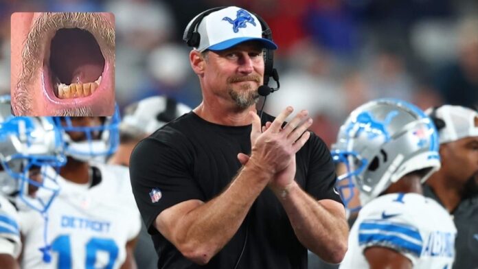 Dan Campbell clapping and teeth