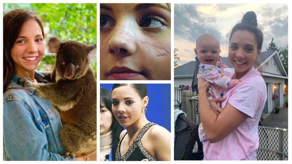 Jessica Dube before and after picture shows her face injury & scar!